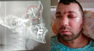 Diş implantı yaptırdı, hayatının şokunu yaşadı