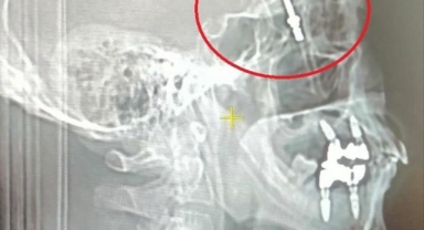 İmplant vidası hastanın beynine saplandı