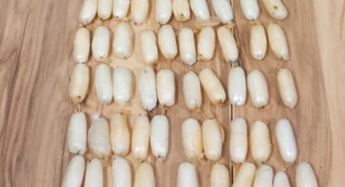 Yabancı uyruklunun bağırsağından çıkarıldı