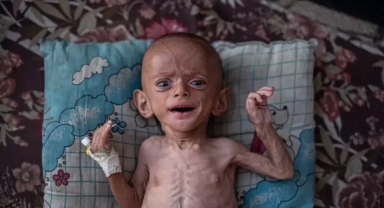 Gazze'deki Göç ve Yetersiz Beslenm