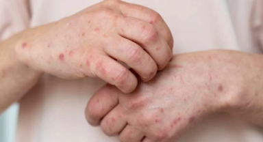 Uyuz vakaları her gün artıyor