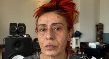 Yıldız Tilbe'nin yüzü yandı