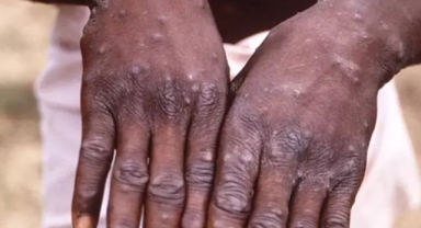 Afrika ülkesinde M çiçeği alarmı! 