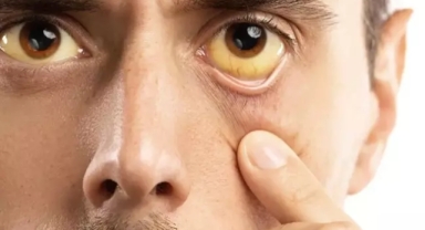 Ülkeyi alarma geçiren sarıhumma salgını