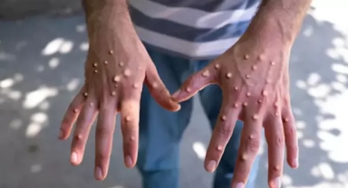 Maymun çiçeği alarmı