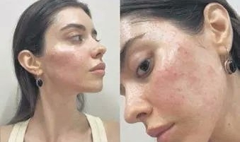 Nursena Say, İnternetten Aldığı Üründen Sonra Gül Hastalığına Yakalandığını Açıkladı