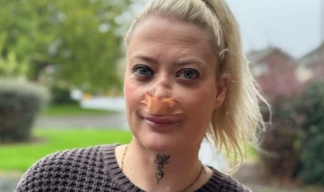 Türkiye’de Diş İmplantı Tedavisi Geçiren İngiliz Kadın Burnunu Delik Bırakan İmplantlar Nedeniyle Güçlük Yaşıyor