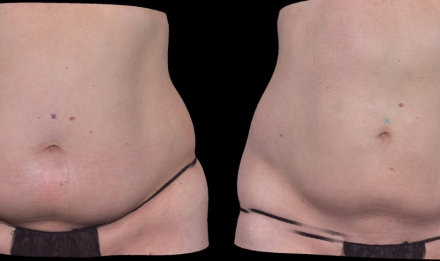 Ameliyatsız Yağ Eritme Dönemi: CBL-514 İlacı Faz 3’e Geçti — Selülit ve Bölgesel Yağda Yeni Umut