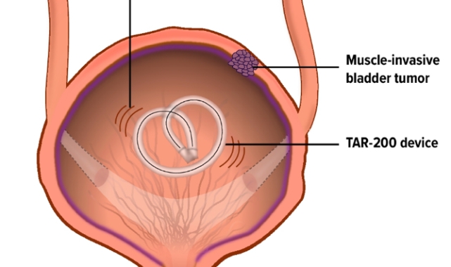 Kanser Tedavisinde Devrim: 3 Ayda Tamamen Yok Eden Yeni Cihaz Onay Yolunda